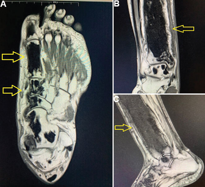 Magnetic resonance images of the (A) foot and (B) ankle showing heterogeneous, sclerotic meta-diaphyseal expansion of the distal tibia. (C) Focal scleroitic areas are seen in the talus, calcaneus, navicular, cuboid, medial cuneiform, 1st metatarsal and phalanges of the big toe.